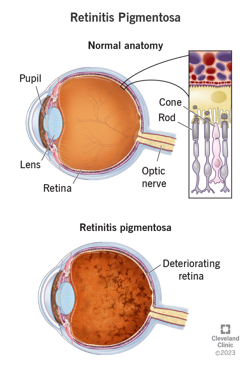 Retinīts pigmentosa ietekmē tīkleni un tās konusus un stieņus;  citas acs daļas ir zīlīte, lēca un redzes nervs.