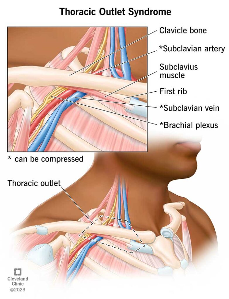 17553 thoracic outlet syndrome illustration.ashx
