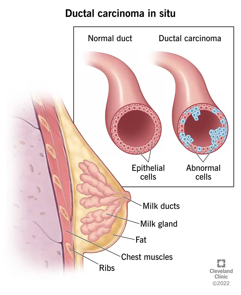 17869 ductal carcinoma