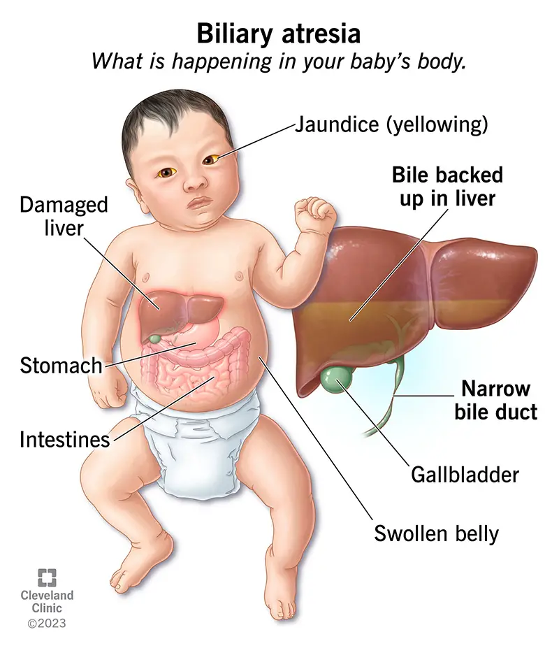 21076 biliary atresia