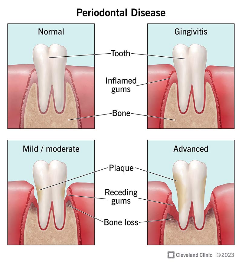 21482 periodontal disease
