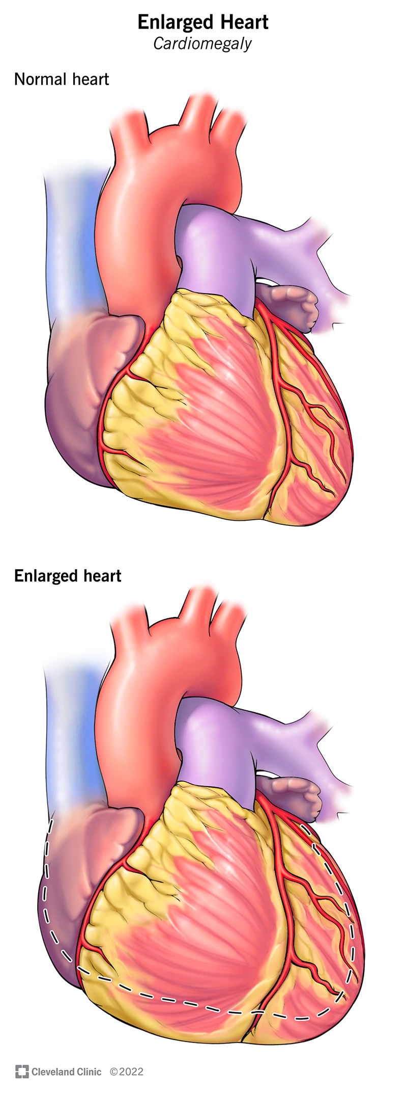 Salīdzinot normālu sirdi ar kardiomegāliju.