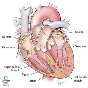 21692 right bundle branch block illustration