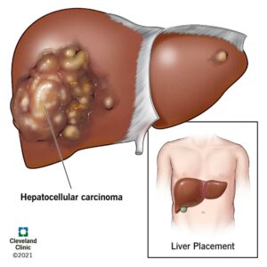 21709 Hepatocellular Carcinoma Illustration