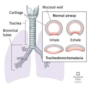 22061 tracheobronchomalacia illustration