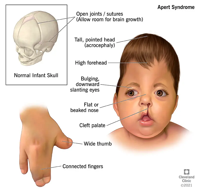 22077 apert syndrome