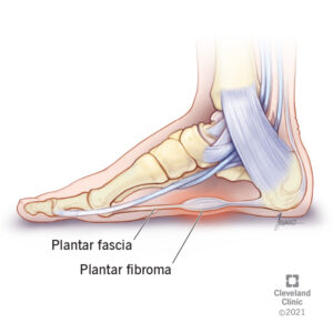 22104 plantar fibroma