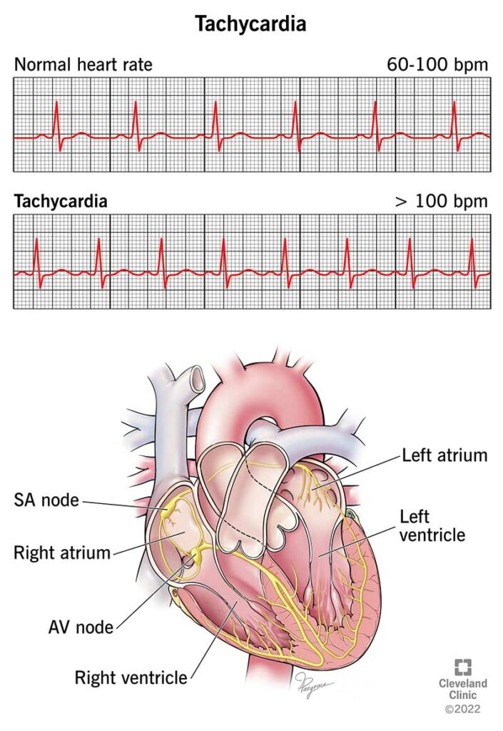 22108 tachycardia illustration