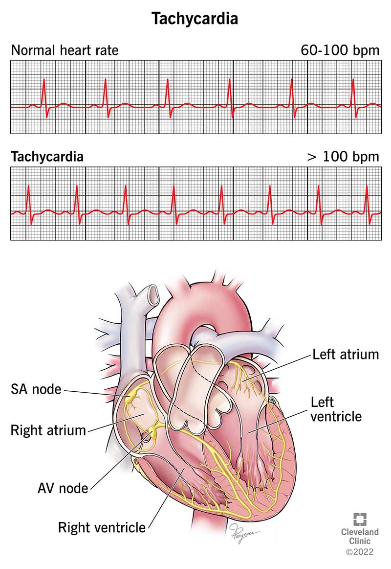 EKG ar vairāk nekā 100 sitieniem minūtē (miera stāvoklī) norāda uz tahikardiju.