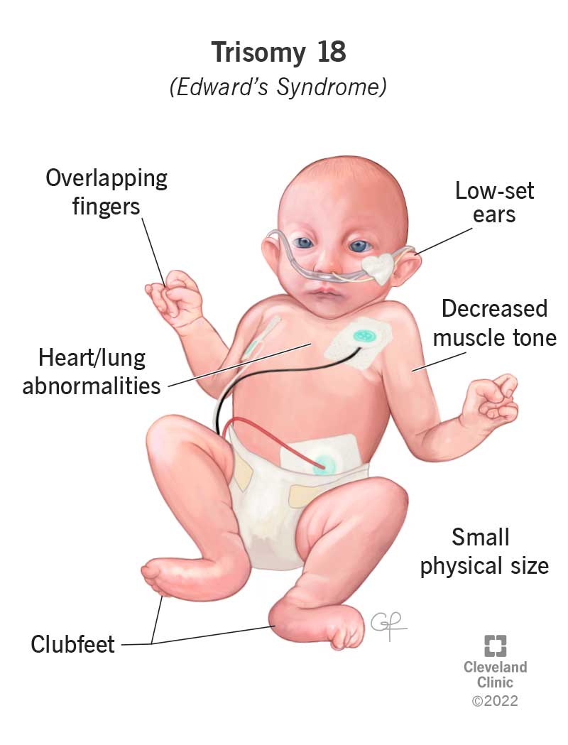 Bērnam, kuram diagnosticēts Edvarda sindroms (18. trisomija), ir unikālas fiziskās īpašības, ko izraisa šis stāvoklis.