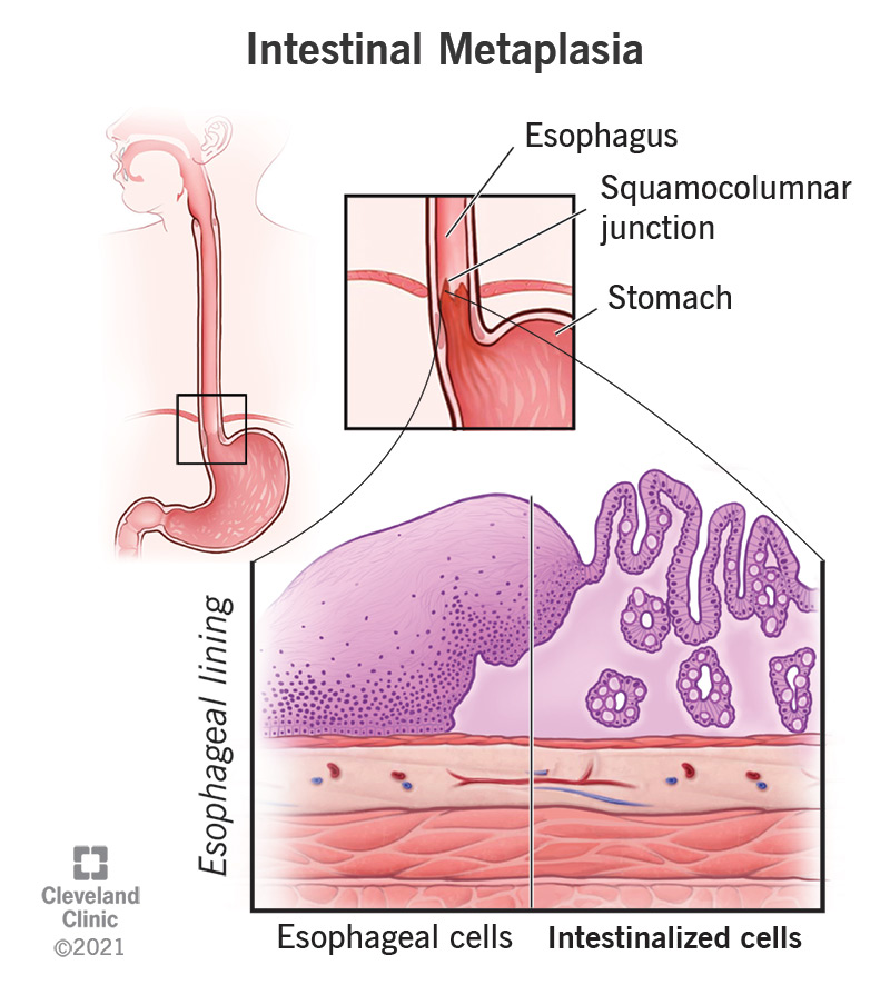 22215 intestinal metaplasia