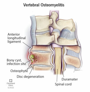 22276 vertebral osteomyelitis spine