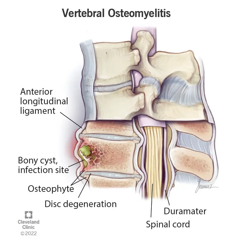 22276 vertebral osteomyelitis spine