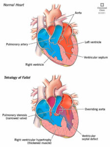 22343 tetralogy of fallot