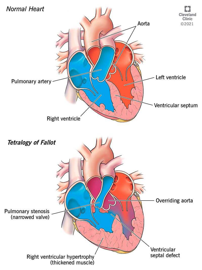 Ilustrācija, kurā parādīti četri sirds defekti, kas izraisa Fallot tetraloģiju.