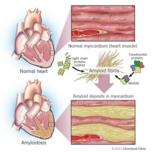 22598 cardiac amyloidosis