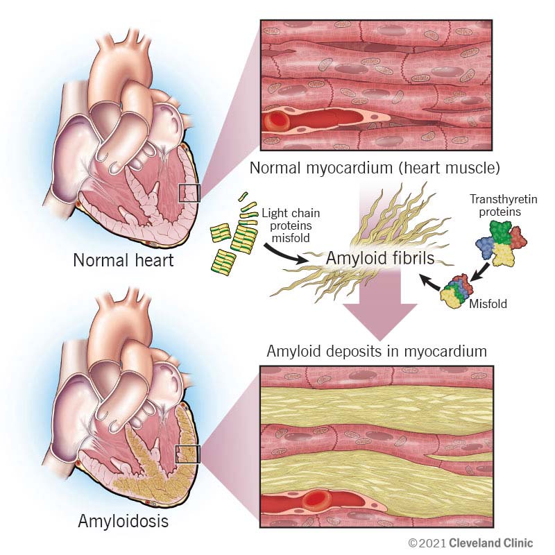 22598 cardiac amyloidosis