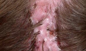 22784 folliculitis decalvans