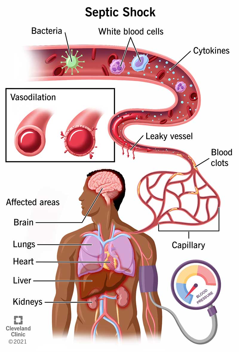 Septiskais šoks rodas, ja bakteriāla infekcija izraisa zemu asinsspiedienu, asinsvadu paplašināšanos un orgānu mazspēju.