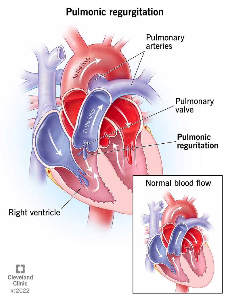 Plaušu regurgitācija ir tad, kad asinis izplūst atpakaļ caur plaušu vārstu, radot pārāk lielu spiedienu uz sirdi.