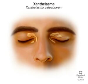 23385 xanthelasma