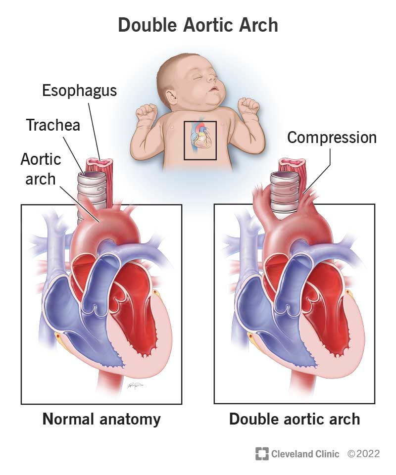 23432 double aortic arch
