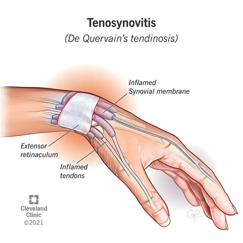 23448 tenosynovitis