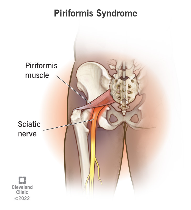 23495 piriformis syndrome