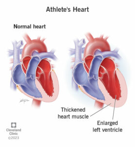 23920 athletes heart