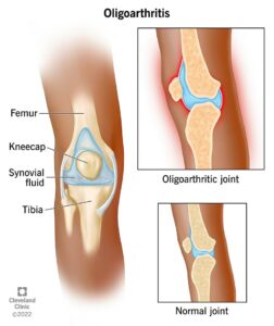 23929 oligoarthritis