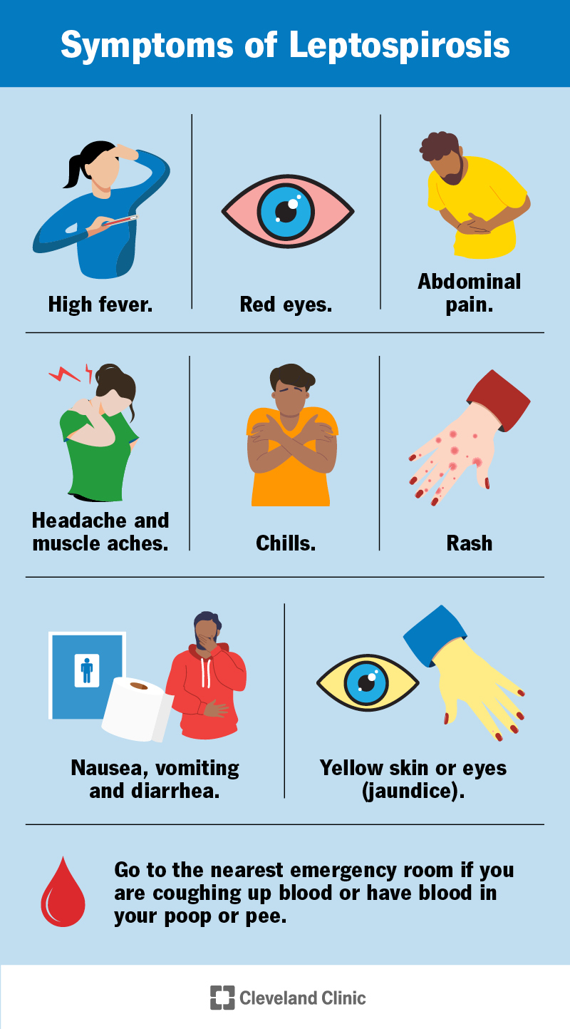 Leptospirozes simptomi ir augsts drudzis, sarkanas acis, galvassāpes, muskuļu sāpes, sāpes vēderā, dzeltena āda vai acis un daudz kas cits.