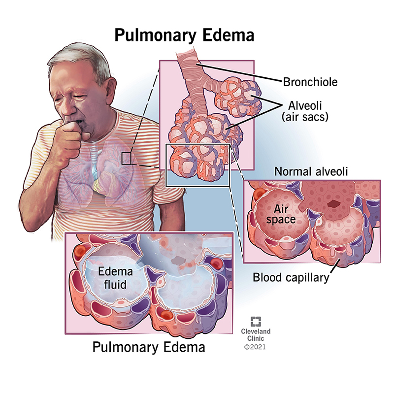 24218 pulmonary edema