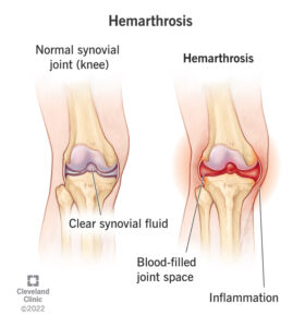 24225 hemarthrosis