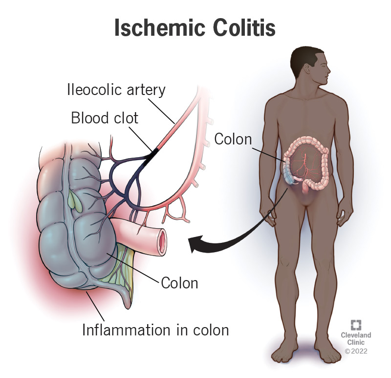 24513 ischemic colitis
