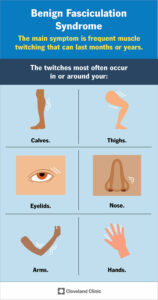 24812 benign fasciculation syndrome