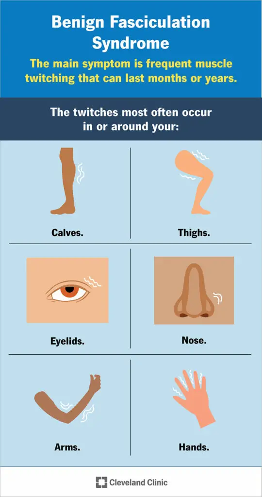 24812 benign fasciculation syndrome