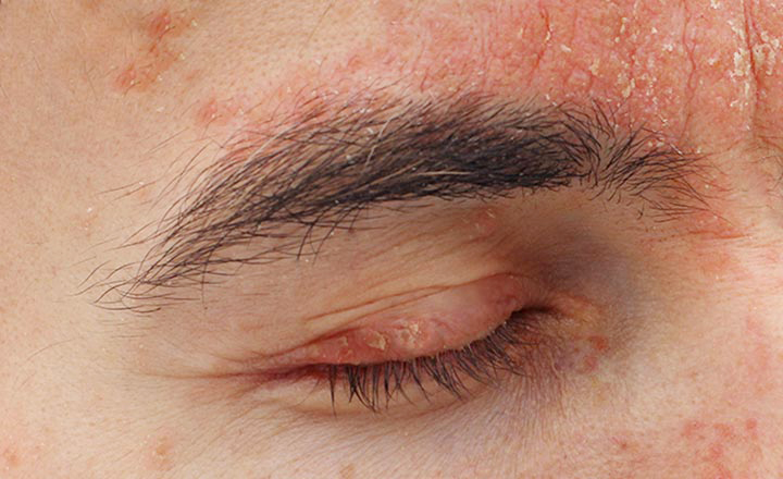 25025 psoriasis on eyelids