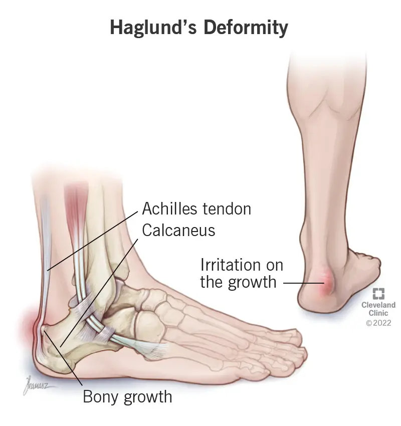 25134 haglunds deformity