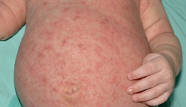 4567 scabies