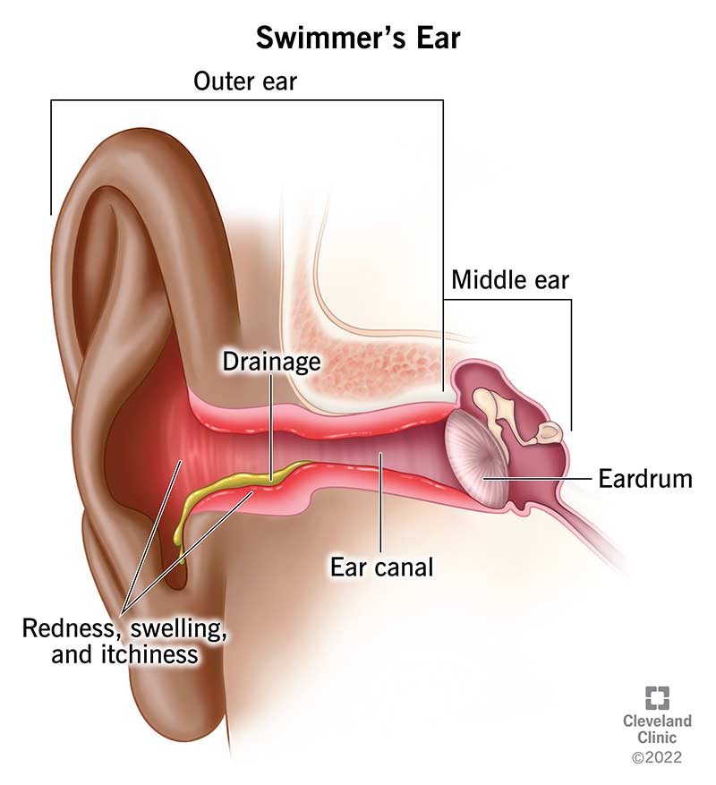 8381 swimmers ear