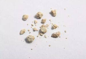 KidneyStones 952988256 770x533 1 jpg