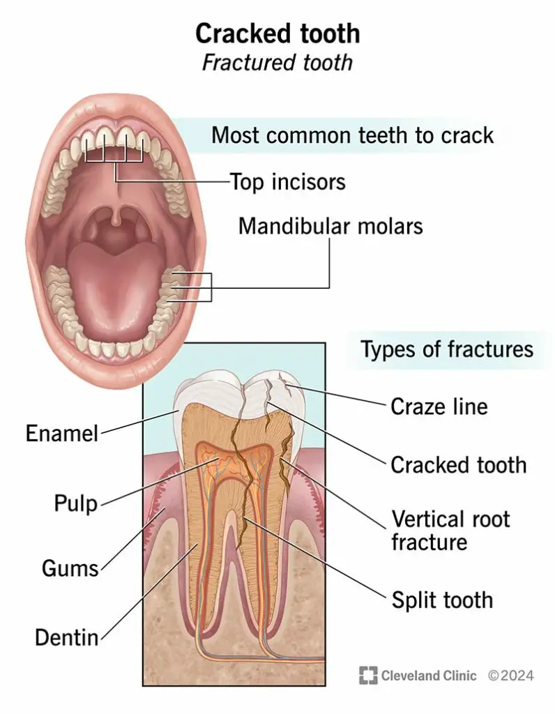 cracked tooth types