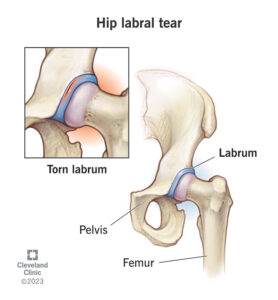 hip labral tear