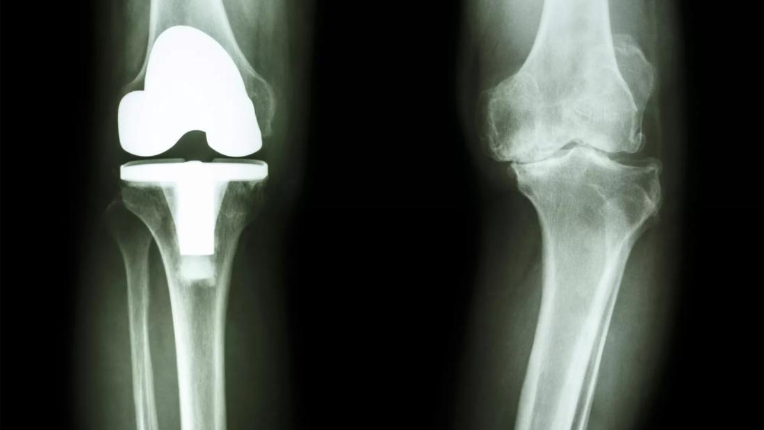 joint replacement xray iStock 000038796200 Large jpg