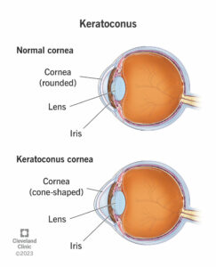 keratoconus