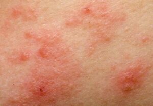 phtotoxicitySkinRash prevOnline 770x533 1 jpg