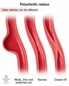 polyarteritis nodosa