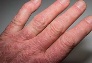 psoriaticRheumatoidArthritis1 182657432 770x533 1 jpg