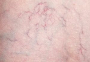 spider Veins on leg 184277101 770x533 1 jpg