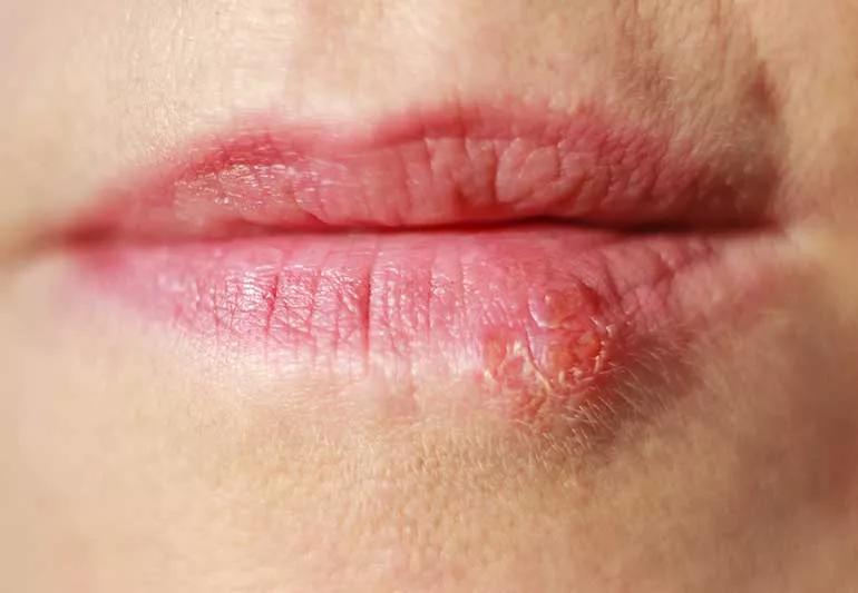 Cold Sore Pimple 1171456453 770x533 1 jpg